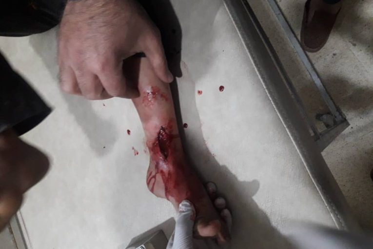 A child was injured in Al-Shahba by the Turkish occupation bullets