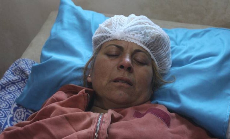 Displaced Afrini woman injury caused by a landmine explosion in al-Shahba areas