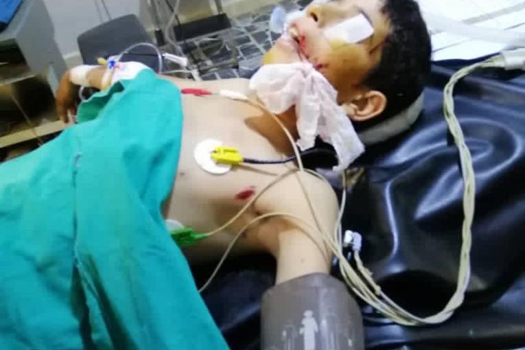 4 children, displaced from Afrin, injured by a landmine explosion, on the International Children's Day