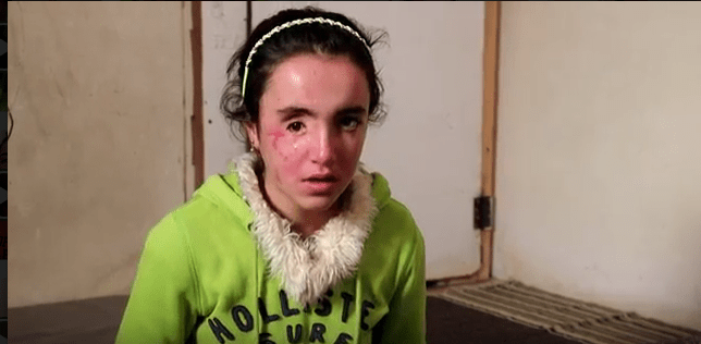 How did a girl from Afrin lose her sight while fleeing the Turkish invasion?